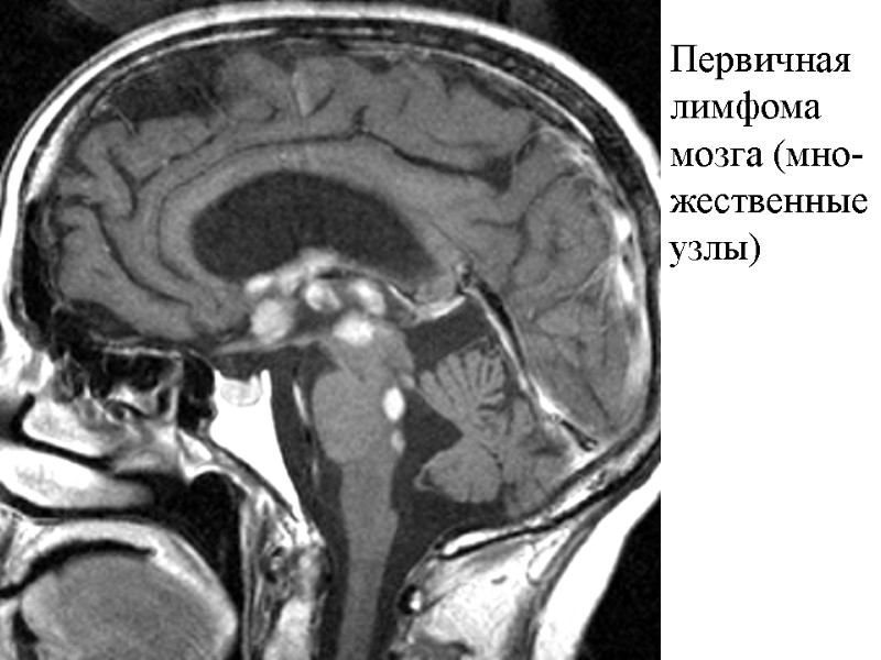 Первичная лимфома  мозга (мно- жественные  узлы)